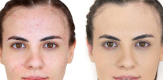 trucos maquillaje acné - Noticias Ahora