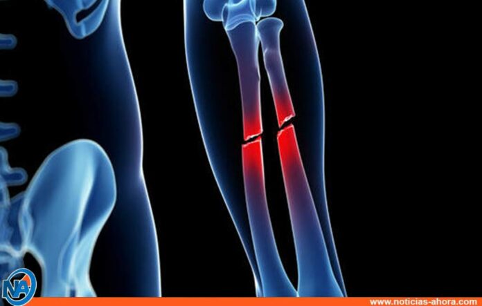 riesgo de sufrir fracturas de huesos - Noticia Ahora