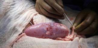 Trasplante de riñón de un cerdo a un humano - Noticias Ahora
