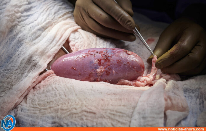 Trasplante de riñón de un cerdo a un humano - Noticias Ahora
