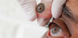 primera prótesis ocular en 3D
