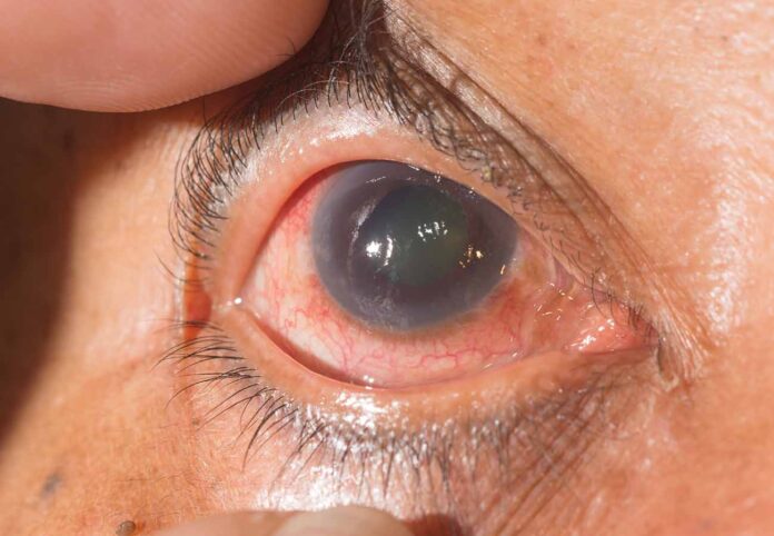 glaucoma enfermedad