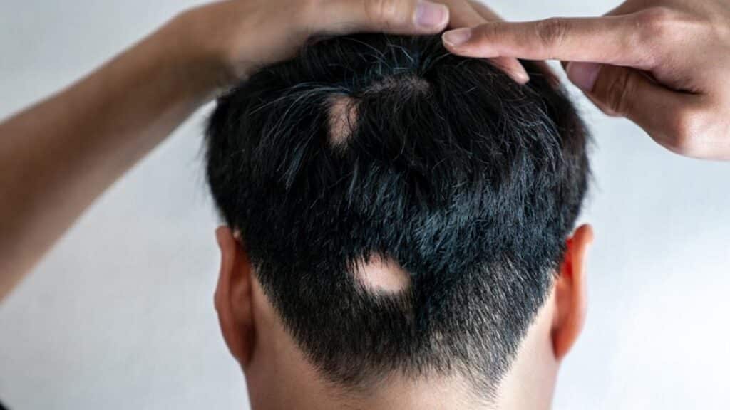 Alopecia areata o parches redondos de calvicie