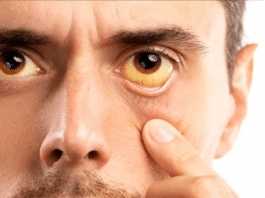 Ojos amarillos