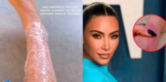 Kim Kardashian y su Lucha Contra la Psoriasis