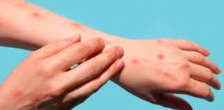 Filipinas primer caso de mpox