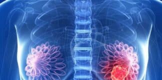 cáncer de mama