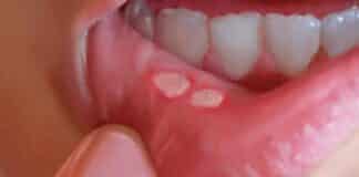 llagas bucales aftas