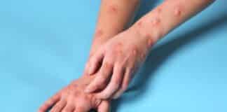 Nueva variante de mpox