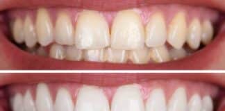Blanqueamiento dental casero
