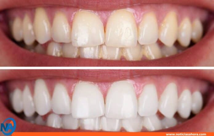 Blanqueamiento dental casero