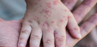 Perú alerta epidemiológica
