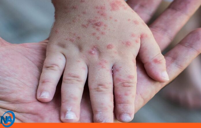 Perú alerta epidemiológica