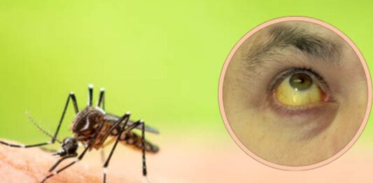 fiebre amarilla síntomas